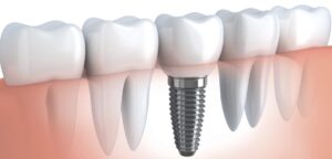 stages of dental implants | Aurora Family Dentistry
