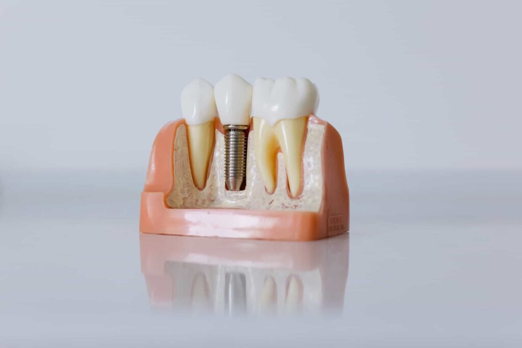 Stages of Implants | Aurora Family Dentistry