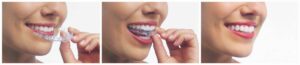 Invisalign Aurora Ontario | Putting Aligners on | Aurora Family Dentistry