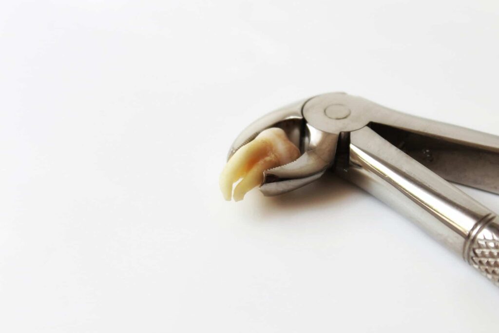 Tooth Extraction | Aurora Family Dentistry