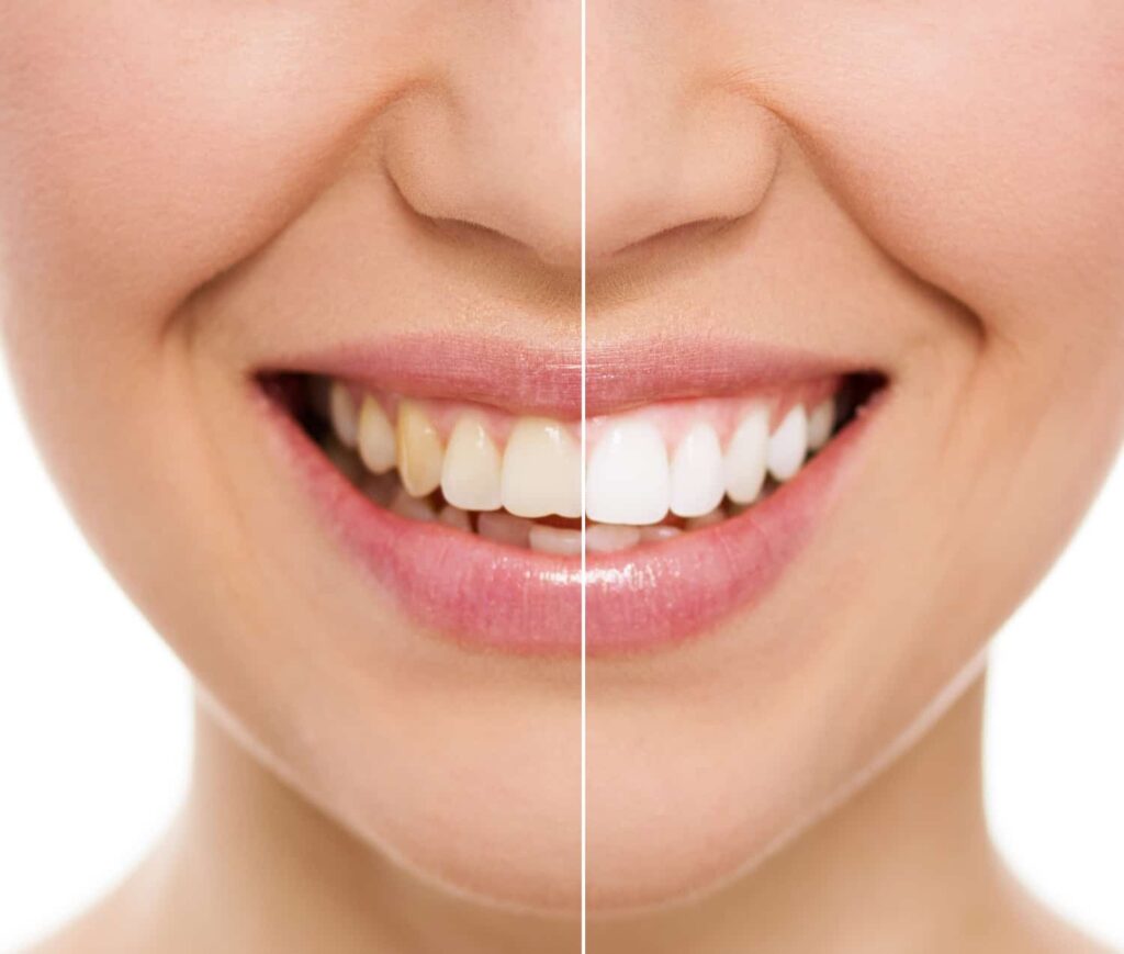Teeth Whitening | Aurora Dental Clinic | Aurora Family Dentistry