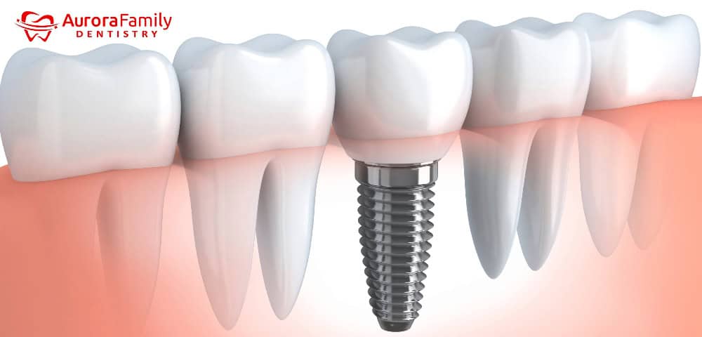Dental Implant Process | Aurora Family Dentistry