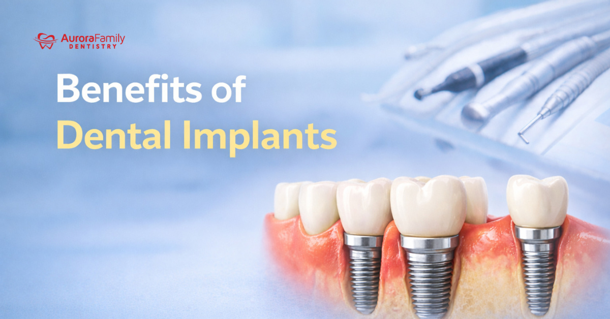 Benefits of Dental Implants