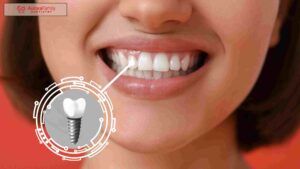 Why Dental Implants Are the Best Solution for Missing Teeth